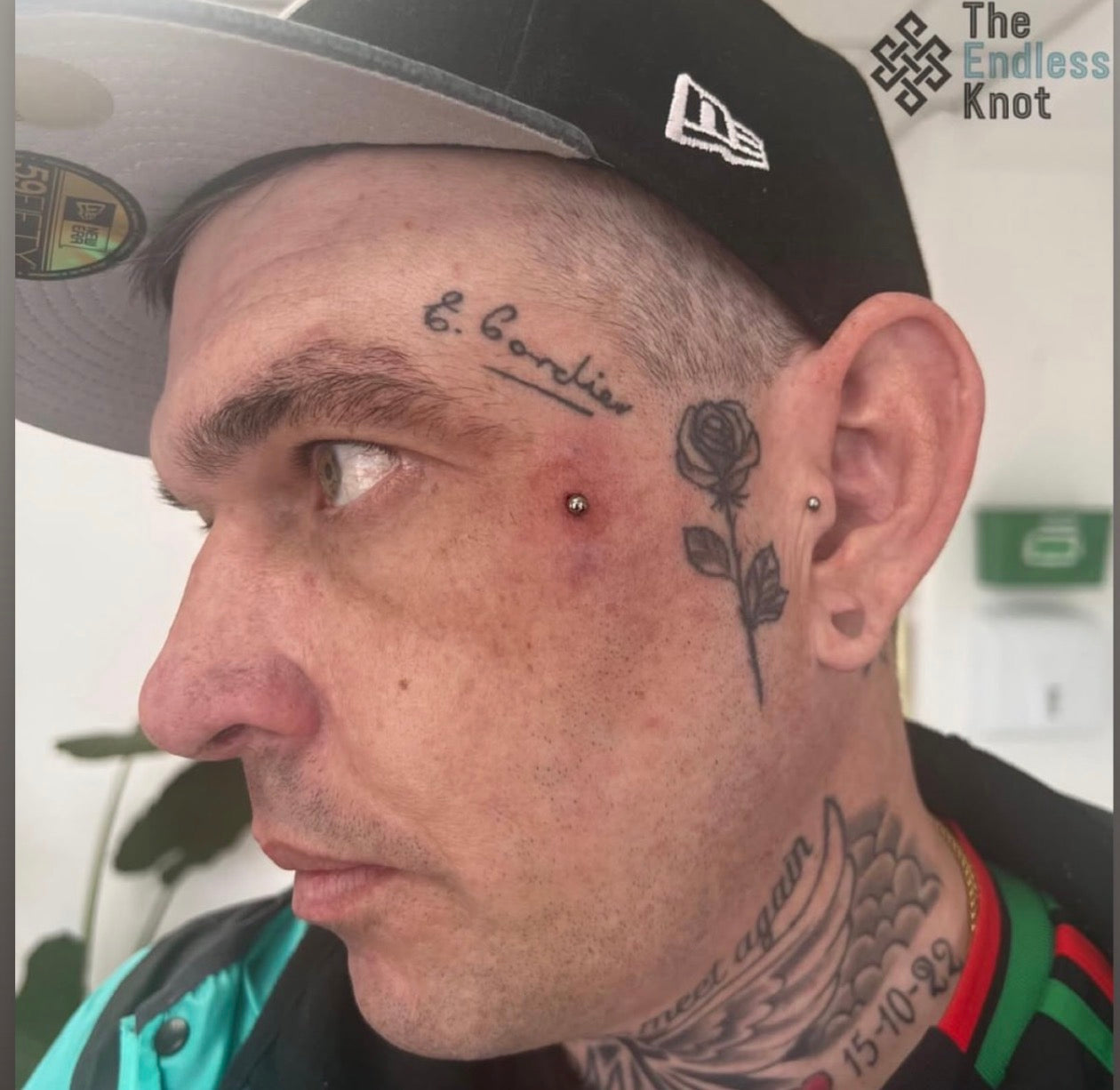 Dermal (One point piercing) / Surface